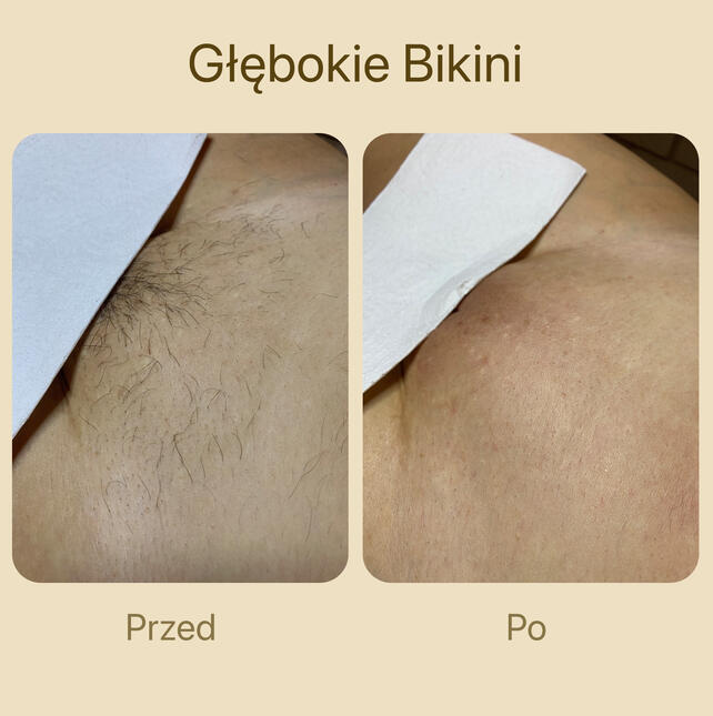 Gładka skóra w okolicy bikini po depilacji pastą cukrową. Głębokie bikini i klasyczne bikini.