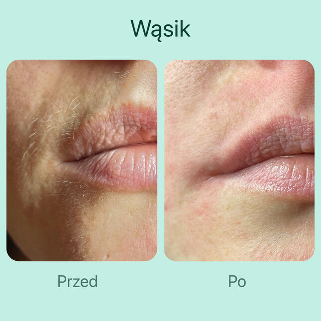 Depilacja wąsika pastą cukrową. Brak podrażnień skóry. Czysty i długotrwały efekt po depilacji.